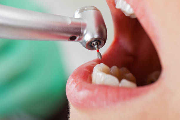 Best Emergency Tooth Extraction in Bethel Manor, VA